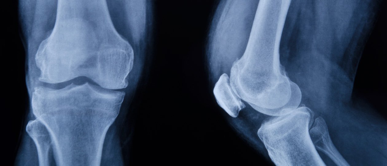 Arthritis-Osteoarthritis-Rheumatoidjpg